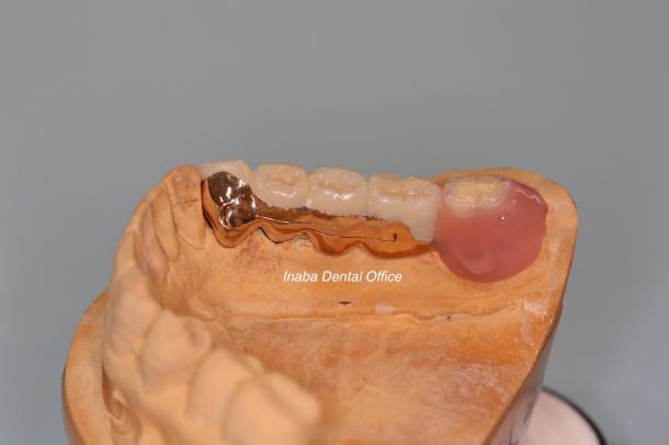 インプラント併用の最新部分入れ歯について
