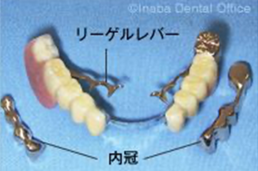 奥歯の部分義歯