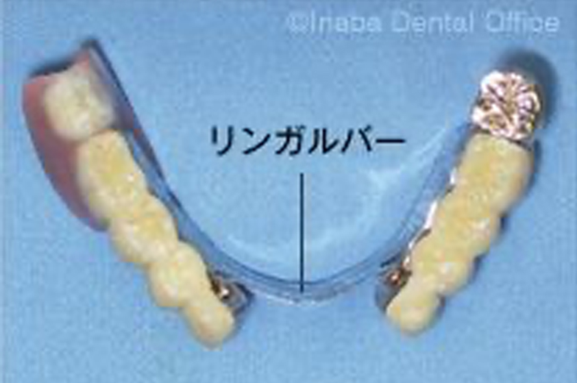 奥歯の部分義歯