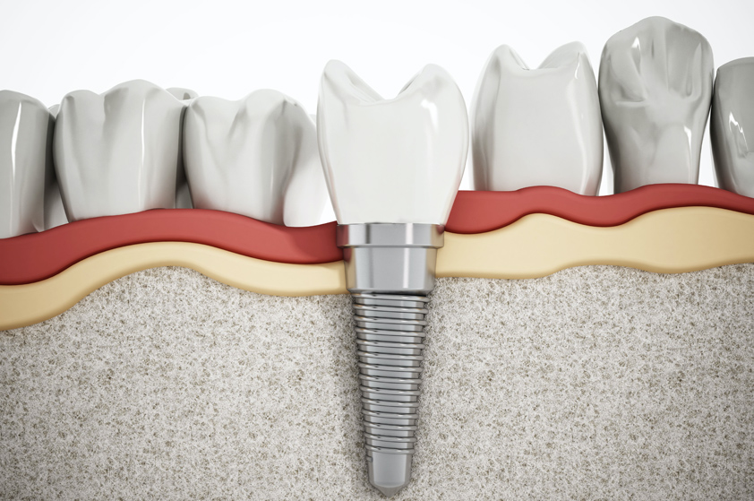 インプラントと義歯の組み合わせ治療について
