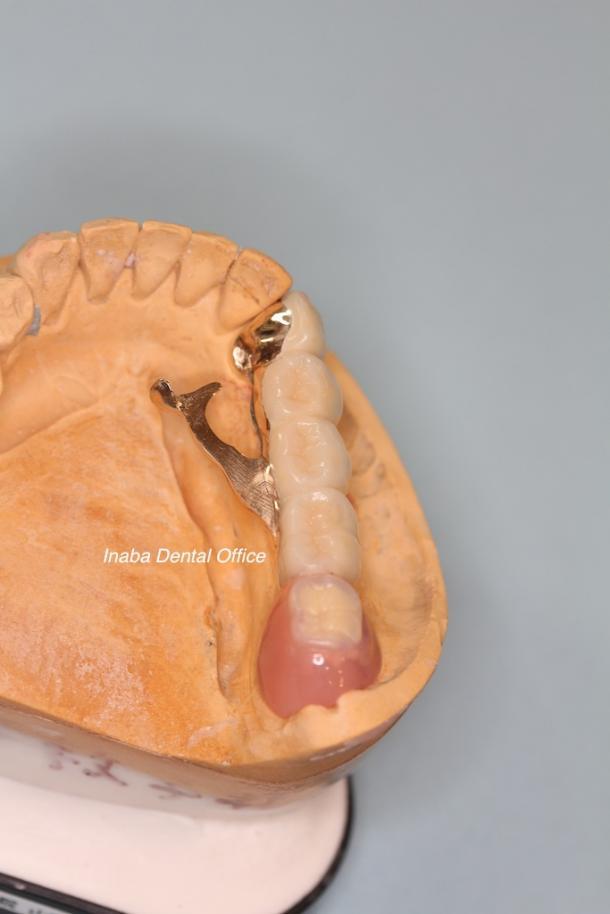 インプラント併用の最新部分入れ歯について