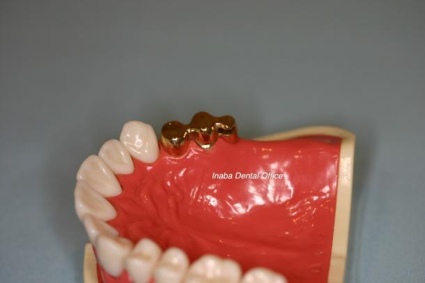 インプラント併用の最新部分入れ歯について