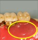 義歯の部分