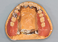 ノンメタルクラスプ部分義歯02