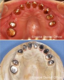 支台歯の形を整え、内冠を被せます。