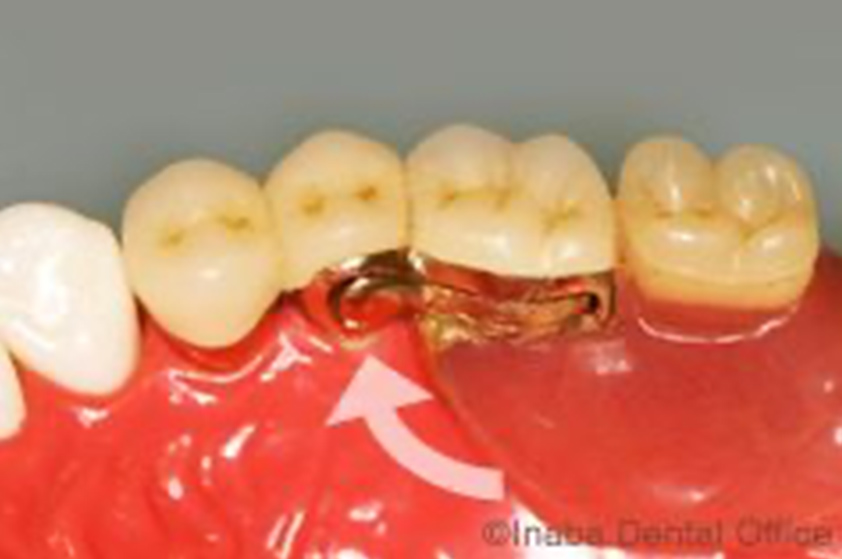 義歯の内側のリーゲルレバーを閉めると、義歯は固定され外れなくなります。