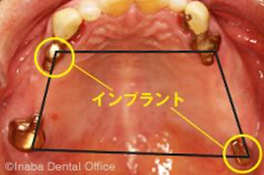 4点支持を作るため、○印の部位にインプラントを埋入しました。