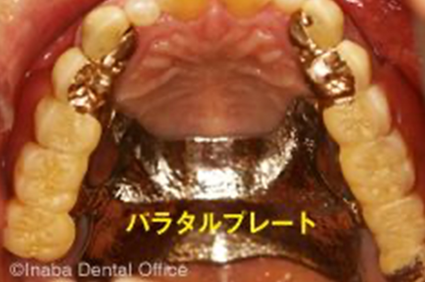 義歯が安定するので、パラタルプレートの面積も小さくできます。