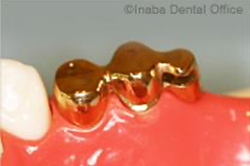 支台歯に専用の内冠を被せます。