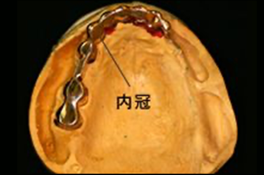 残った歯に内冠を被せます。