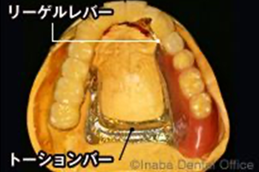 その上にリーゲルレバー付きのトーションバーを用いた義歯を被せます。