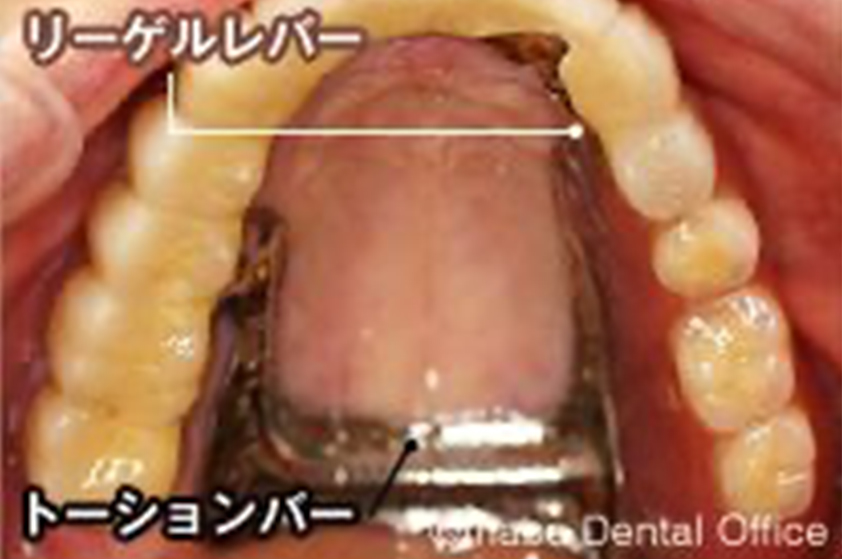 口蓋部を覆う面積を小さくできます。