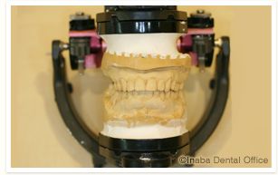 診断用歯列模型のでき上がりです。