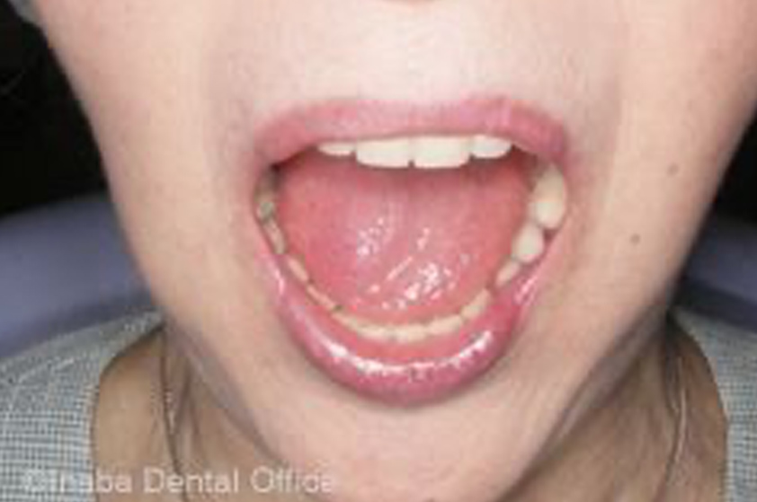 「上下顎同時印象法」で総義歯を作られた患者様。口を大きく開けても浮き上がりません。