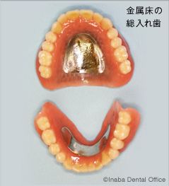 金属床の総義歯