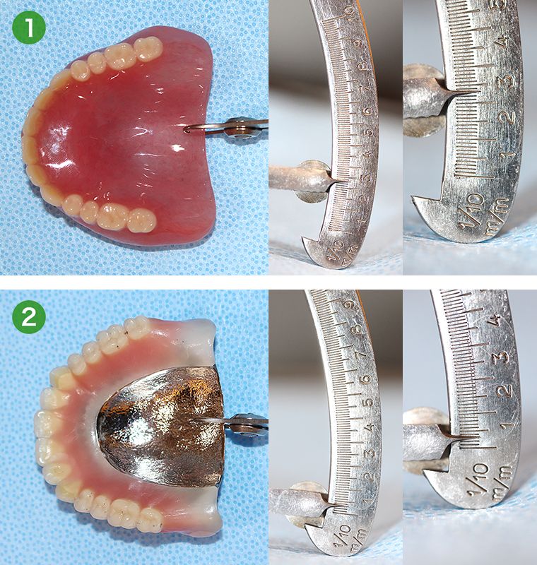 保険診療のレジン床と金属床義歯の厚みの比較