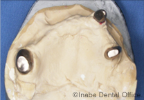 残った歯(3本)に内冠をかぶせます。