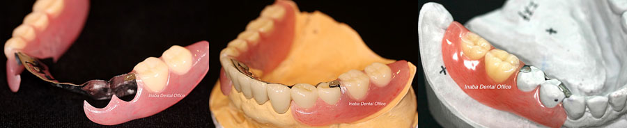 ノンメタルクラスプ義歯の一例