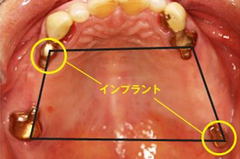 インプラント埋入