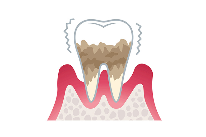 ・歯周炎（重度）