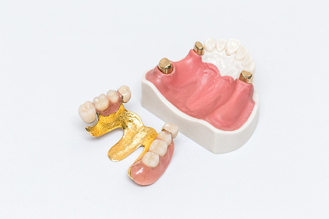 インプラントと義歯の組み合わせも可能です